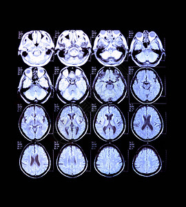 脑部射线照相神经成像头部医学监测X射线MRICT图片