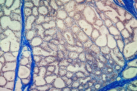 显微镜下的乳腺癌组图片