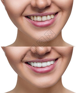 年轻女子的牙齒在白种前后背景图片