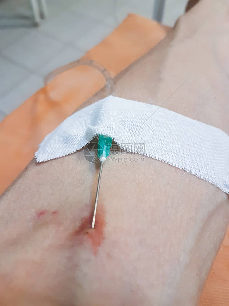 医用滴管通过针头将药物直接注入医院患者的静脉图片