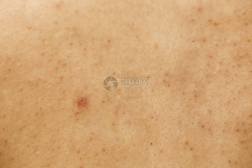 女人的问题皮肤痤疮疤痕油皮肤和毛孔黑斑和脸上图片