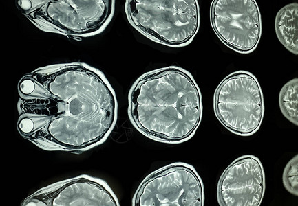 磁共振图像大脑的核磁共振扫描图片