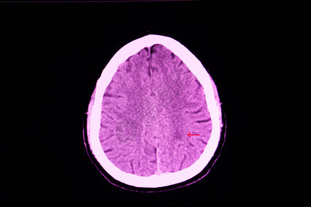 脑梗塞患者右腿无力的CT扫描显示左内囊后肢的低密度区域背景图片