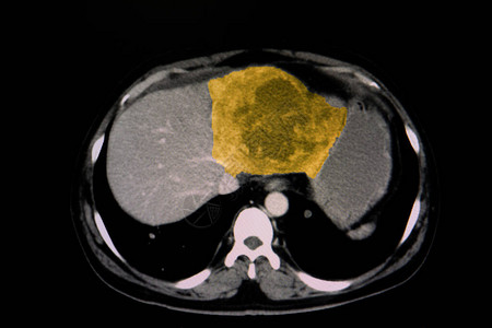 病人肝脏的CT扫描显示肝脏质量大图片