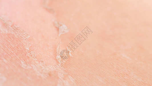 皮肤被晒太阳剥皮身体护理主题复制图片