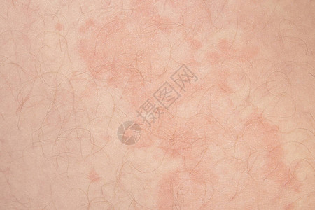 皮肤病荨麻疹皮肤红斑和瘙痒图片