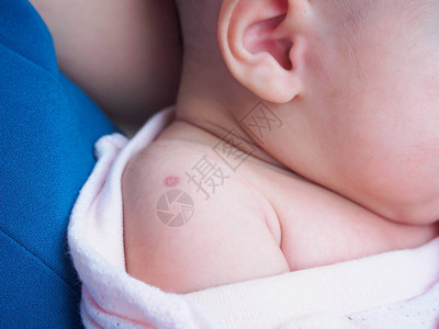 用于防治结核病的BacillusCalmetteGuerinBCG疫苗对新生儿婴肩背景