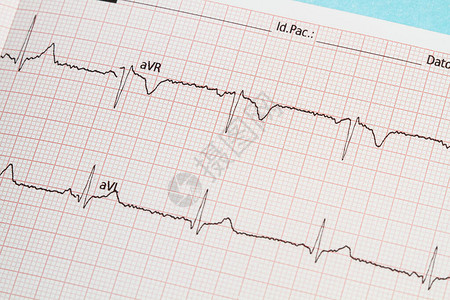 用纸打印的心电图的一部分图片