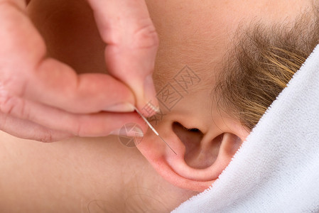 针灸在耳朵上的特写镜头一位脊椎按摩师在金发女人耳朵上应用图片