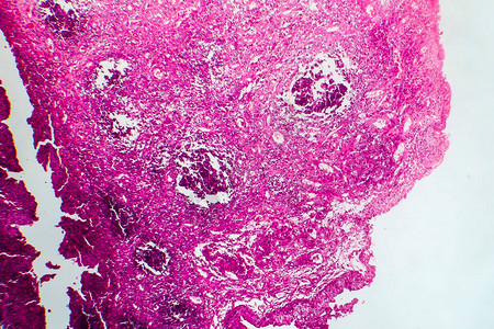 刀型癌症轻显微镜显背景图片