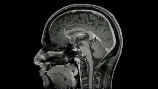大脑成像相电磁共振图像图片