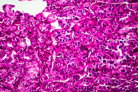 肾癌轻显微镜显背景图片