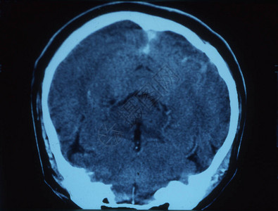 人头扫描素材射线图像中带大脑的人头背景