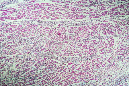 心脏肌肉发炎作为心背景图片