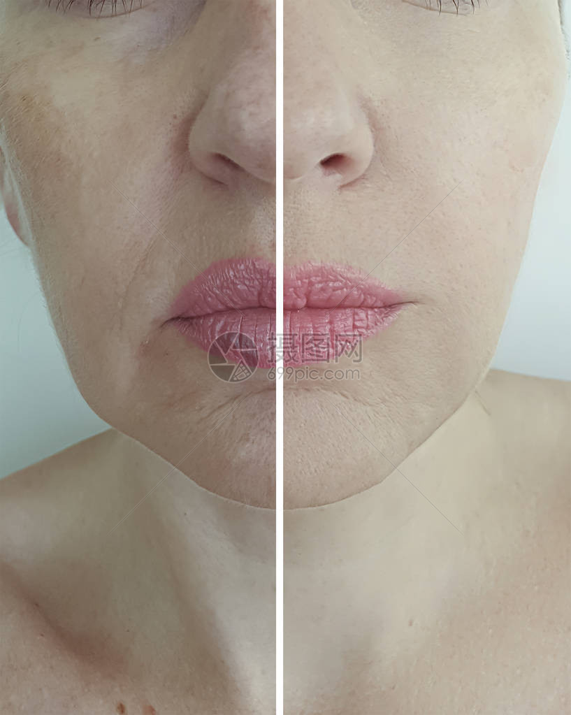 面部女皱纹治疗前后图片