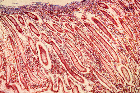 结肠癌病变组织100x图片