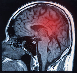 MRI扫描大脑显示结果脑ICH图片