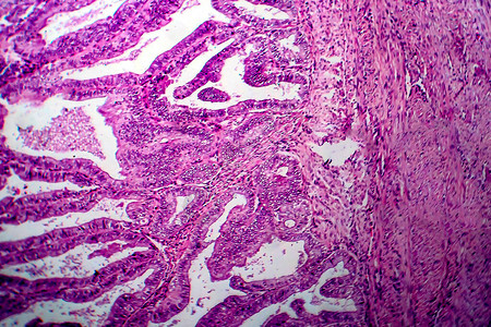 子宫内膜腺癌背景图片