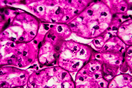 肾癌轻显微镜显微镜下的照图片