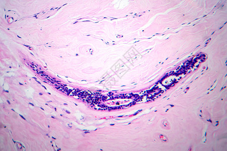 子宫腺纤维瘤图片