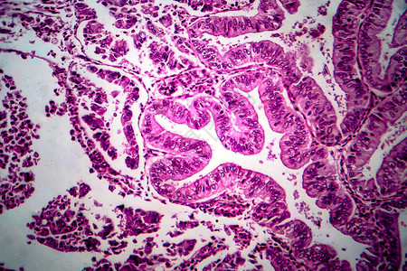 子宫内膜腺癌图片