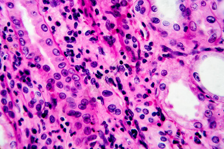 慢白血炎轻显微镜显微镜下的照背景图片