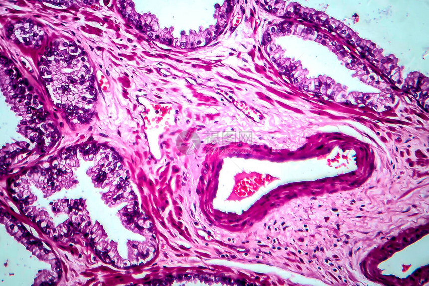 前列腺癌轻显微镜显图片
