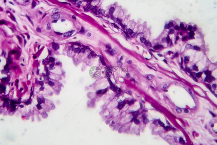 前列腺癌轻显微镜显图片