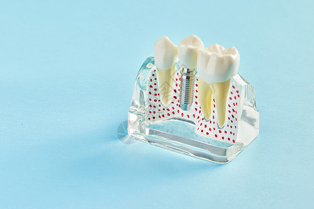 护理概念牙龈牙齿模型背景