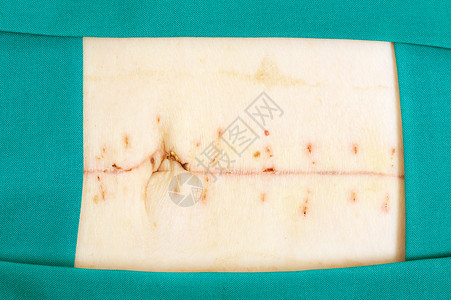 外科手术后腹部上的疤图片