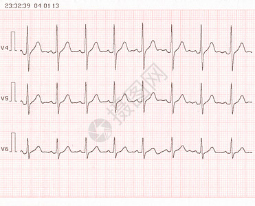 心电图ECG图片