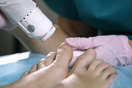 治疗脚趾甲真菌感染的肿瘤口腔炎图片