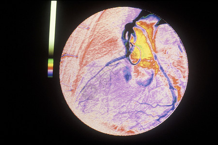 通过血管造影术观察的动图片
