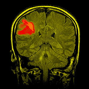 脑癌X射线背景图片