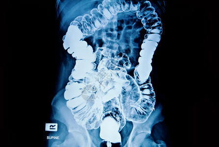 男肺部和脑积水表现出正常图片