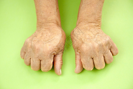 从类风湿关节炎变形的妇女的手绿色背景背景图片