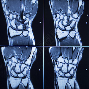 MRI磁共振成像核扫描测试结果手图片