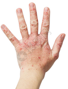 许多人的问题手头上的湿疹与图片