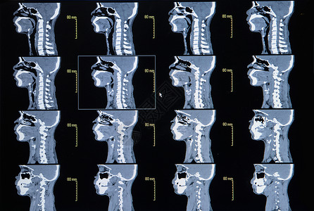 从计算机化颈部宫颈骨XXXXXXX图片