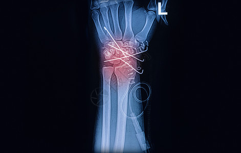 手腕关节X光图像用K线固定图片