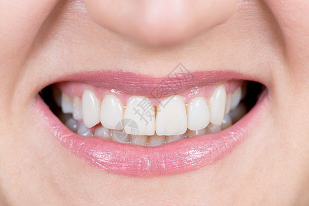 女人微笑修复牙齿牙图片