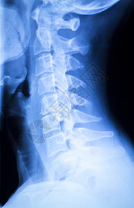 疼痛的颈部和脊椎损伤X射线扫描创伤和图片
