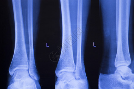 用于诊断运动受伤的脚跟和脚踝X射线创伤学和矫形图片