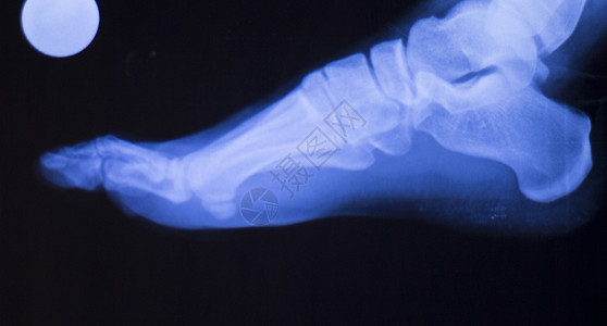 用于诊断运动受伤的脚趾脚跟和脚踝X射线创伤图片