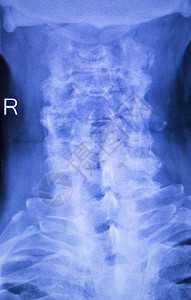 用于诊断运动受伤和关节炎症状的颈部和脊椎X射线创伤学和整形脊椎膜图片