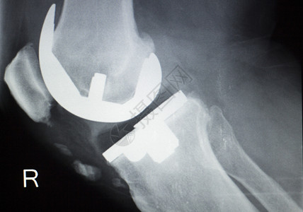 Knee联合替换矫形整钛金属创伤球和安插植入的老年图片