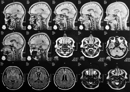 大脑的磁共振成像图片