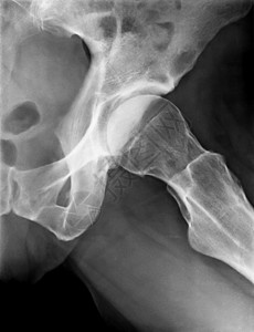 女左髋X光片人体骨骼图像图片