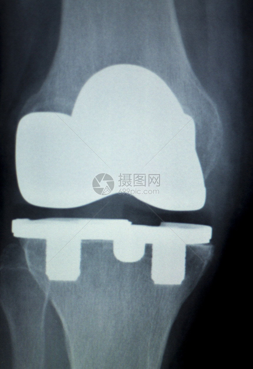 骨科膝关节半月板韧带肌腱和软骨损伤钛现代金属植入物图片