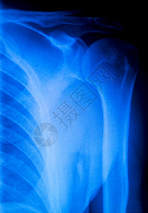 创伤学家用来诊断缺律和所需治疗的X射线测试扫描结果图片